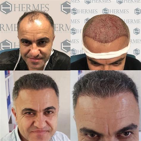 hermes hair clinic yorum|Hermes hair transplant istanbul.